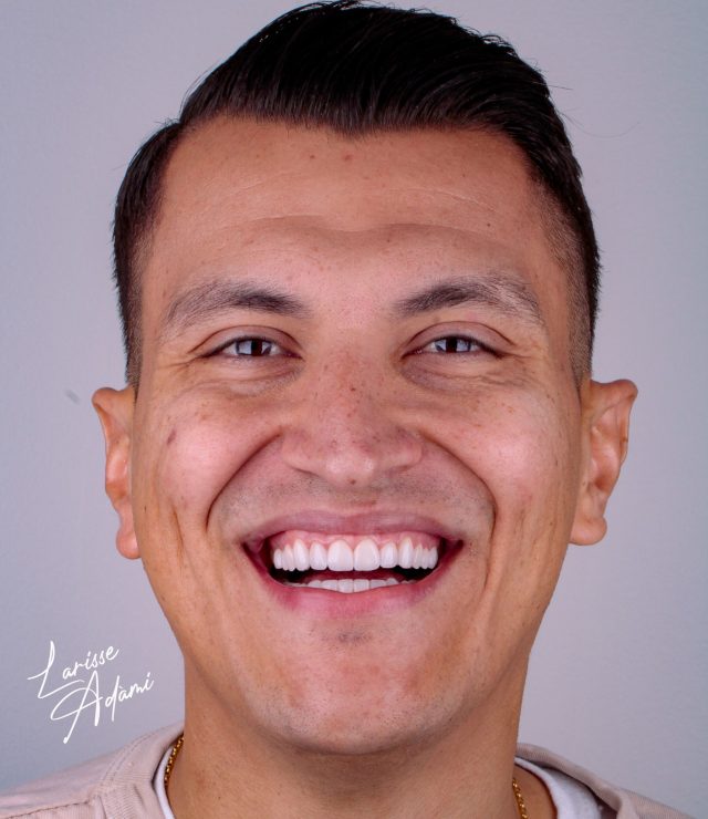lente de contato dental