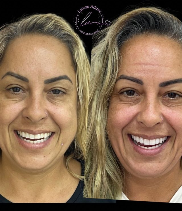 lente de contato dental