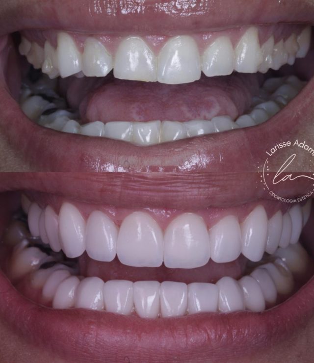 lente de contato dental
