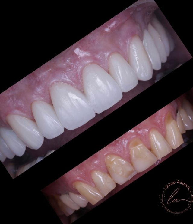 lente de contato dental