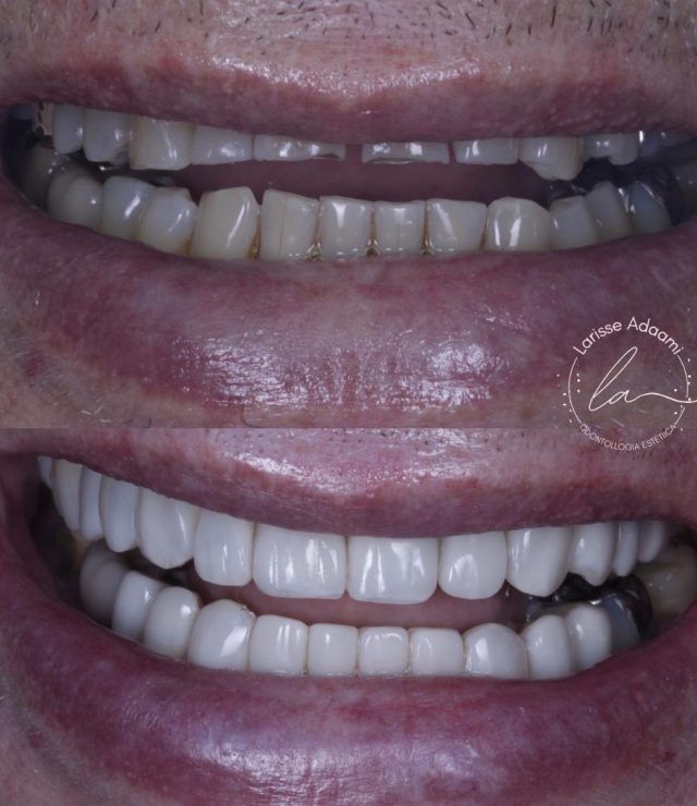lente de contato dental