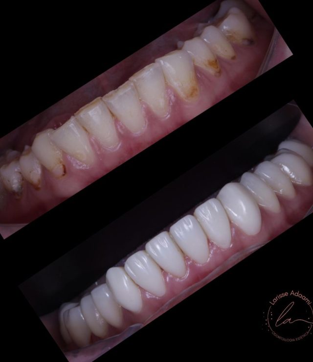 lente de contato dental