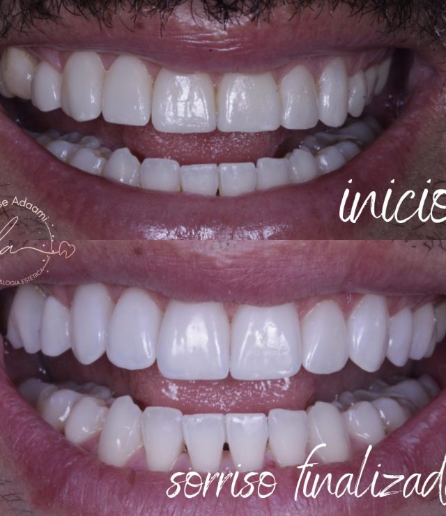 lente de contato dental