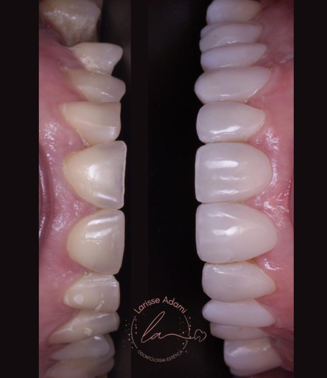 lente de contato dental
