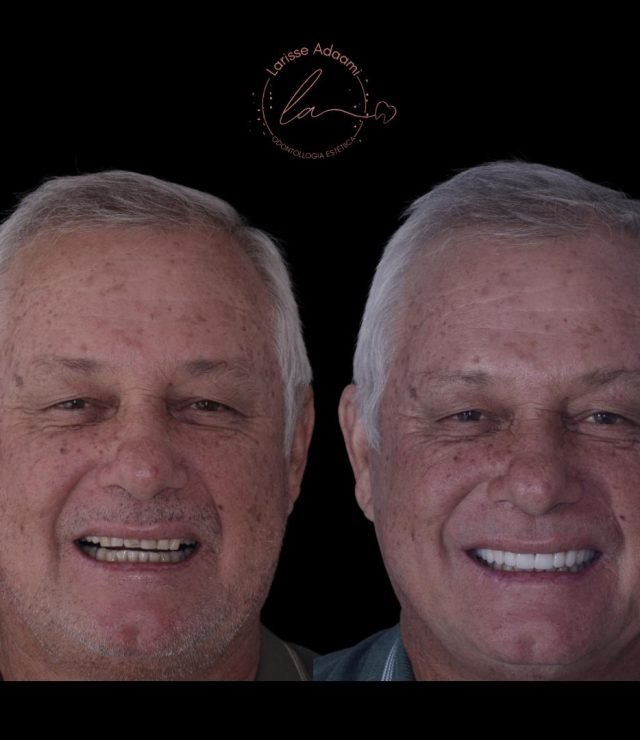 lente de contato dental