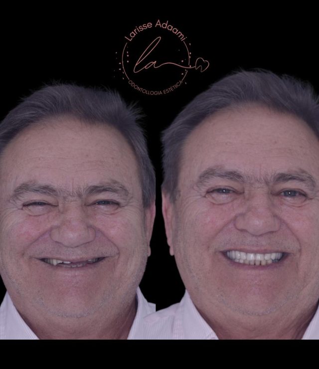 lente de contato dental